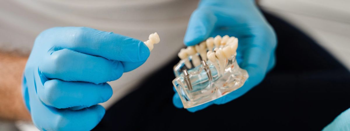 Zahnimplantate setzen